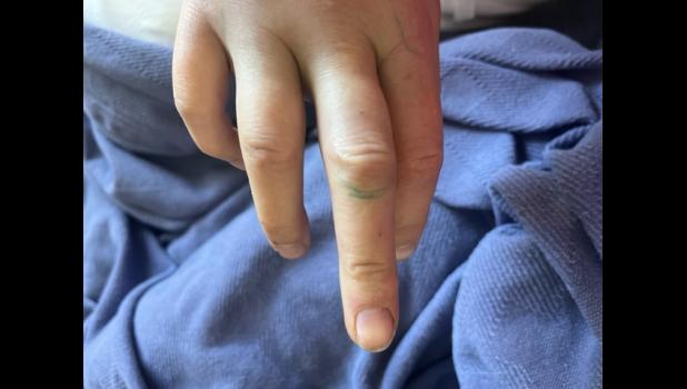Showing small puncture marks in her middle and ring fingers. Courtesy Photo